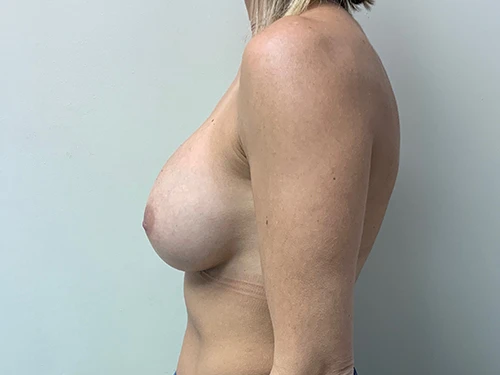 Breast Augmentation