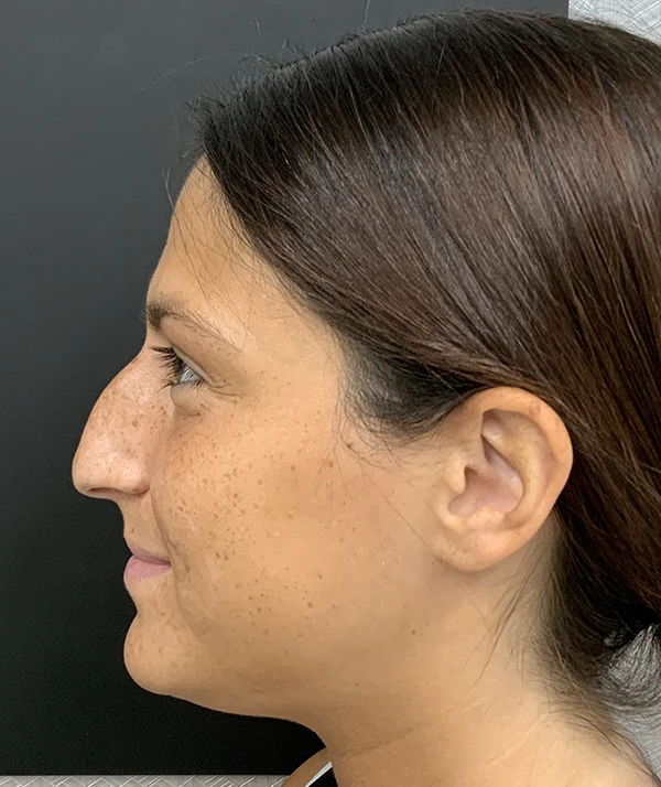 Rhinoplasty