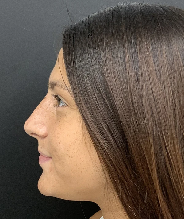 Rhinoplasty