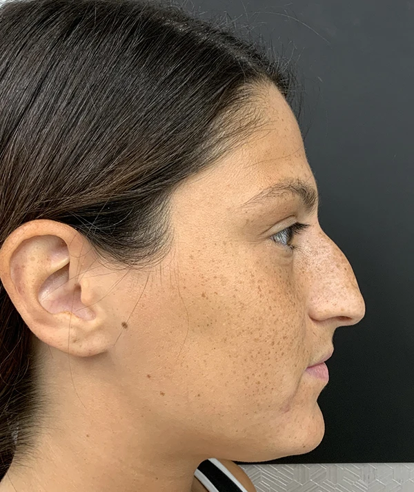 Rhinoplasty