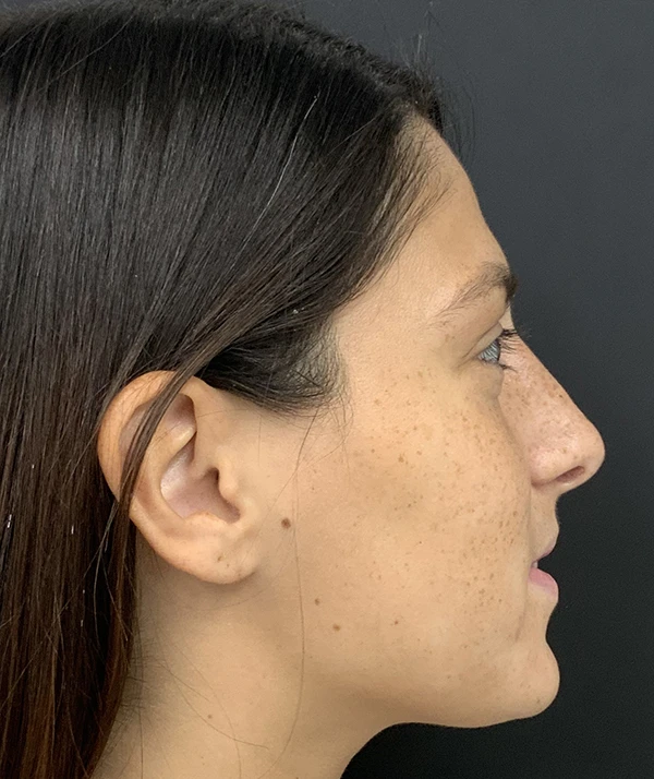 Rhinoplasty