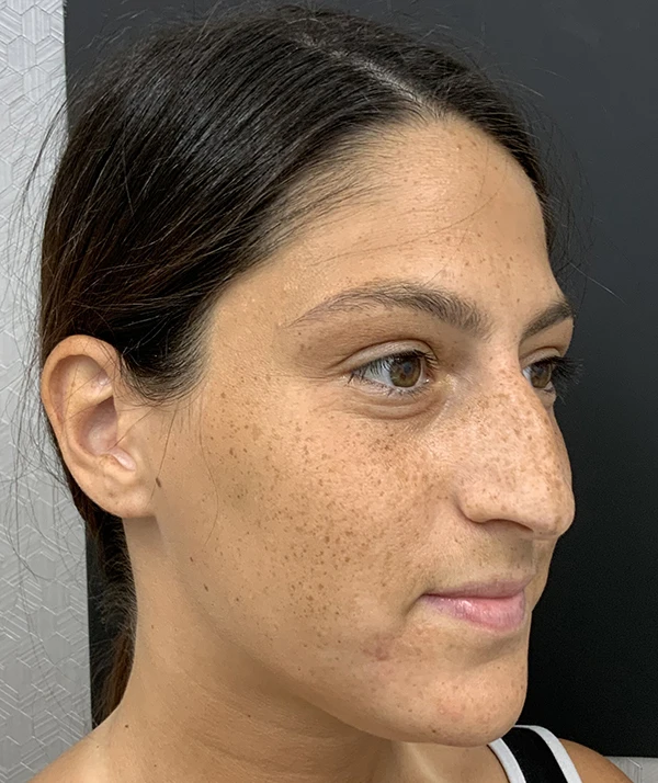 Rhinoplasty