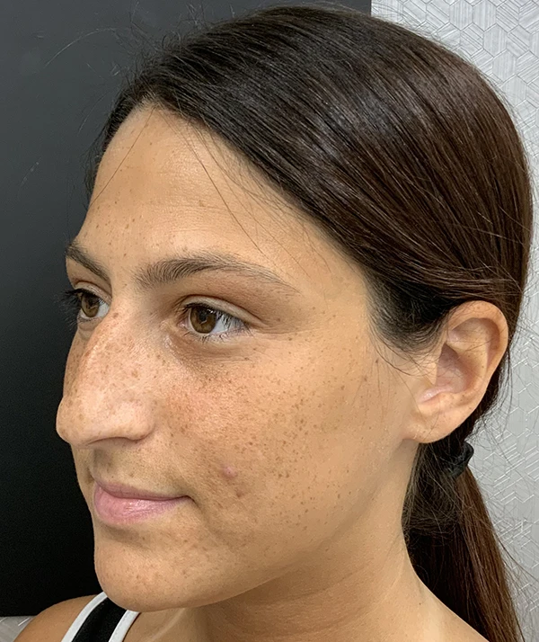 Rhinoplasty