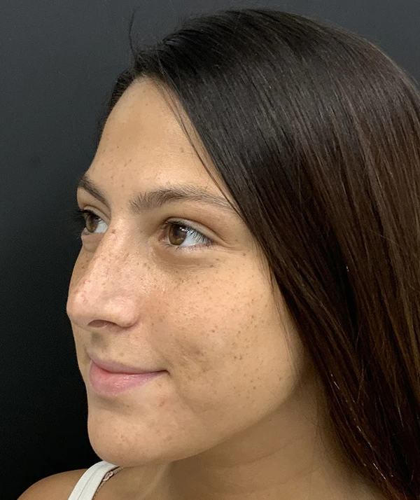 Rhinoplasty