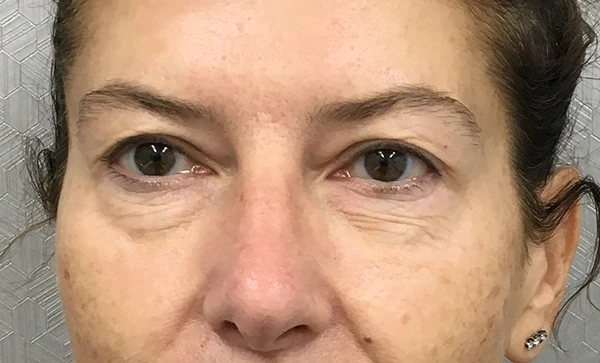 Blepharoplasty