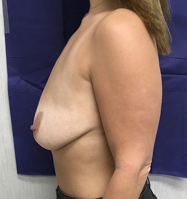 Breast Augmentation with Lift