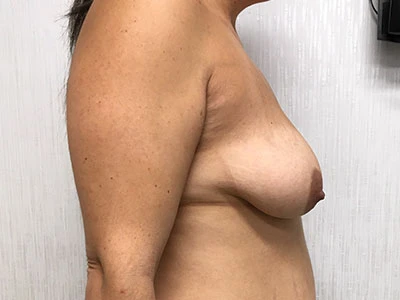 Breast Augmentation with Lift