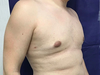 Gynecomastia