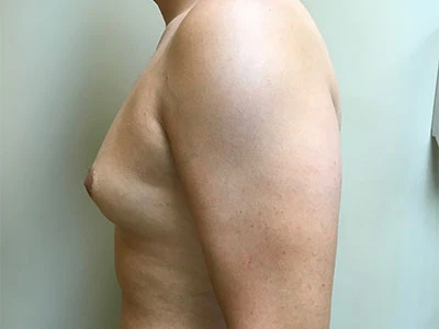 Gynecomastia