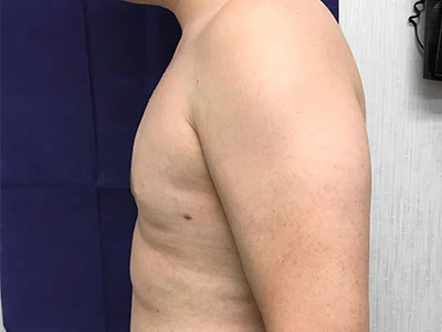 Gynecomastia