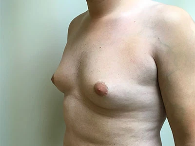 Gynecomastia