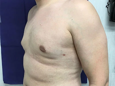 Gynecomastia