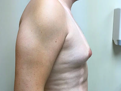 Gynecomastia