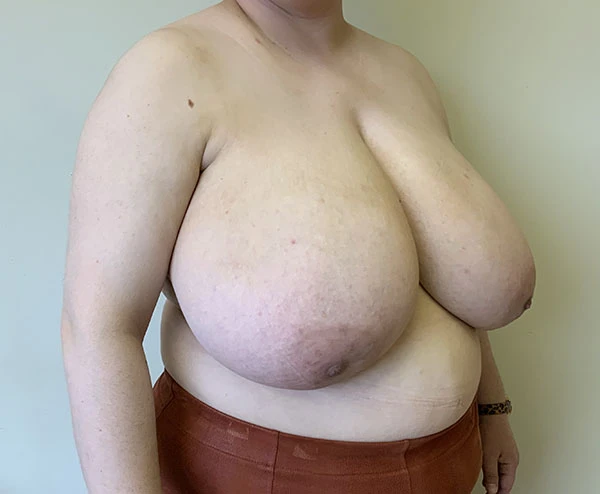 Breast Reduction