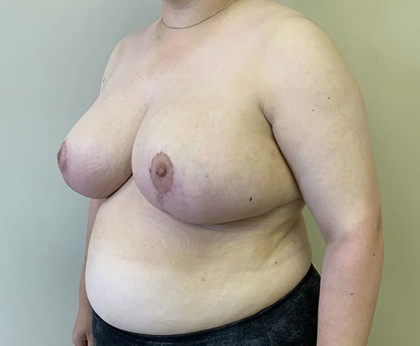 Breast Reduction