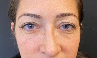 Blepharoplasty