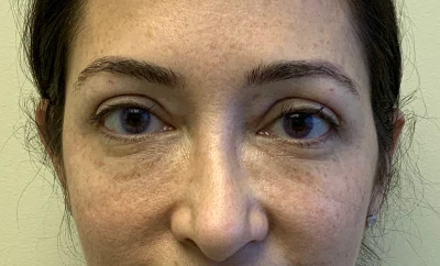 Blepharoplasty