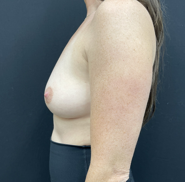 Breast Augmentation