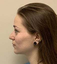 Rhinoplasty