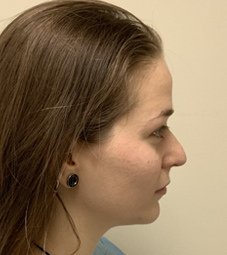 Rhinoplasty