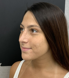 Rhinoplasty