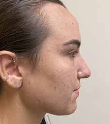 Rhinoplasty