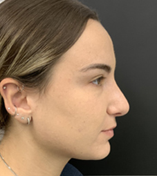 Rhinoplasty