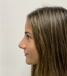 Rhinoplasty