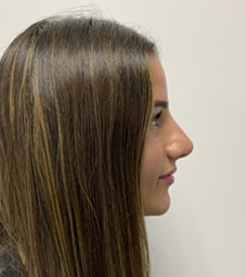 Rhinoplasty