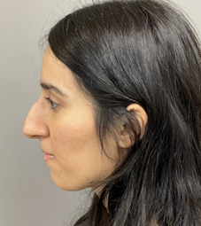 Rhinoplasty