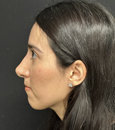 Rhinoplasty