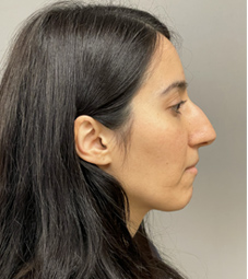 Rhinoplasty