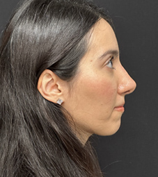 Rhinoplasty