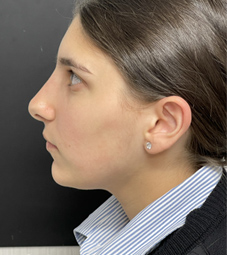 Rhinoplasty