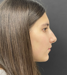 Rhinoplasty