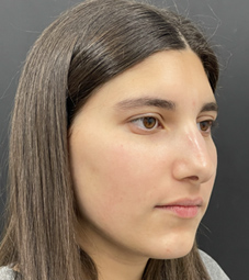 Rhinoplasty