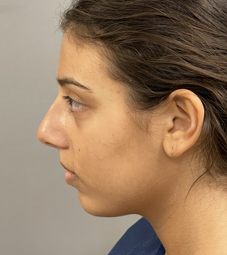 Rhinoplasty