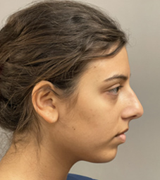 Rhinoplasty