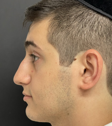 Rhinoplasty