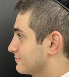 Rhinoplasty