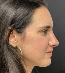 Rhinoplasty