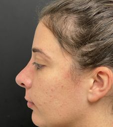 Rhinoplasty