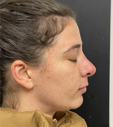 Rhinoplasty