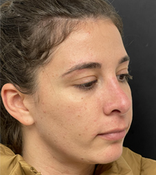 Rhinoplasty