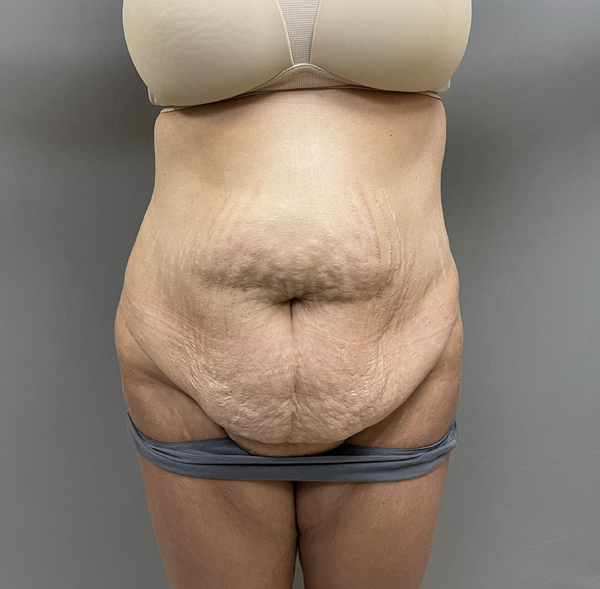 Tummy Tuck