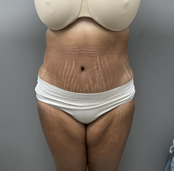 Tummy Tuck