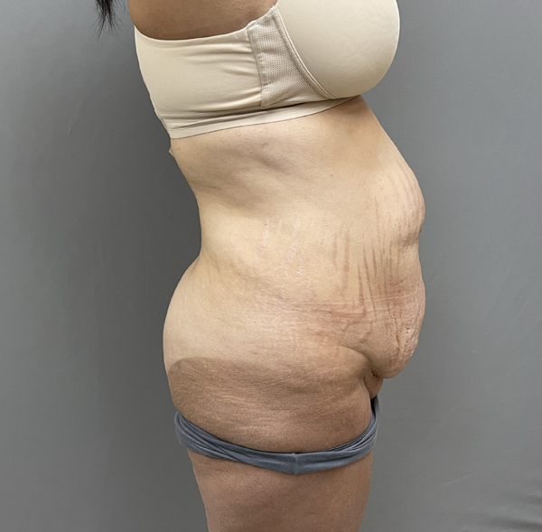 Tummy Tuck