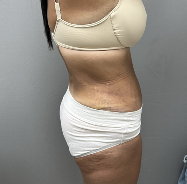 Tummy Tuck