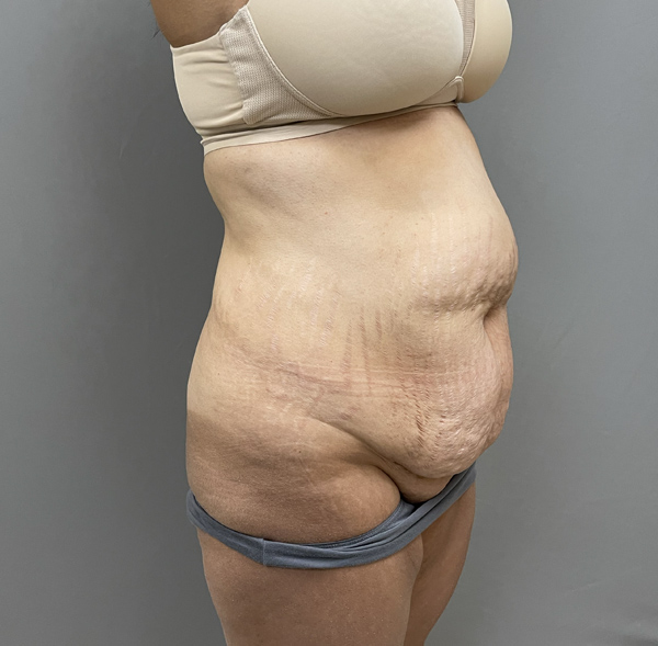 Tummy Tuck