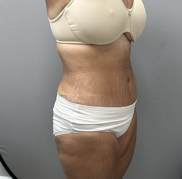 Tummy Tuck
